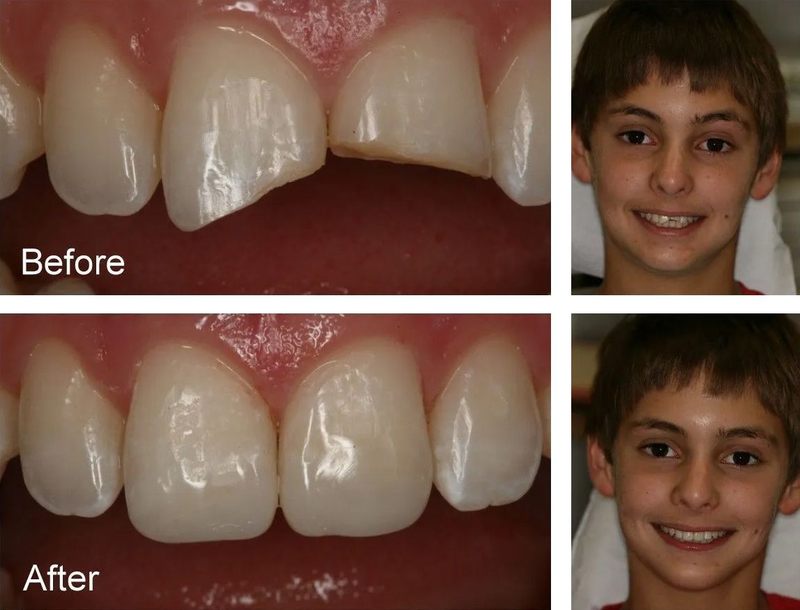 A before and after photo of a young boy's teeth.