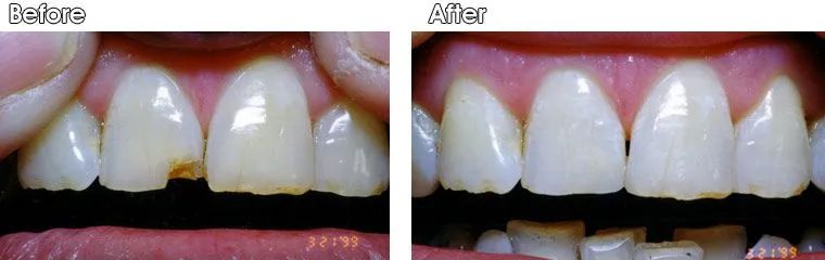 A before and after picture of a person's teeth.
