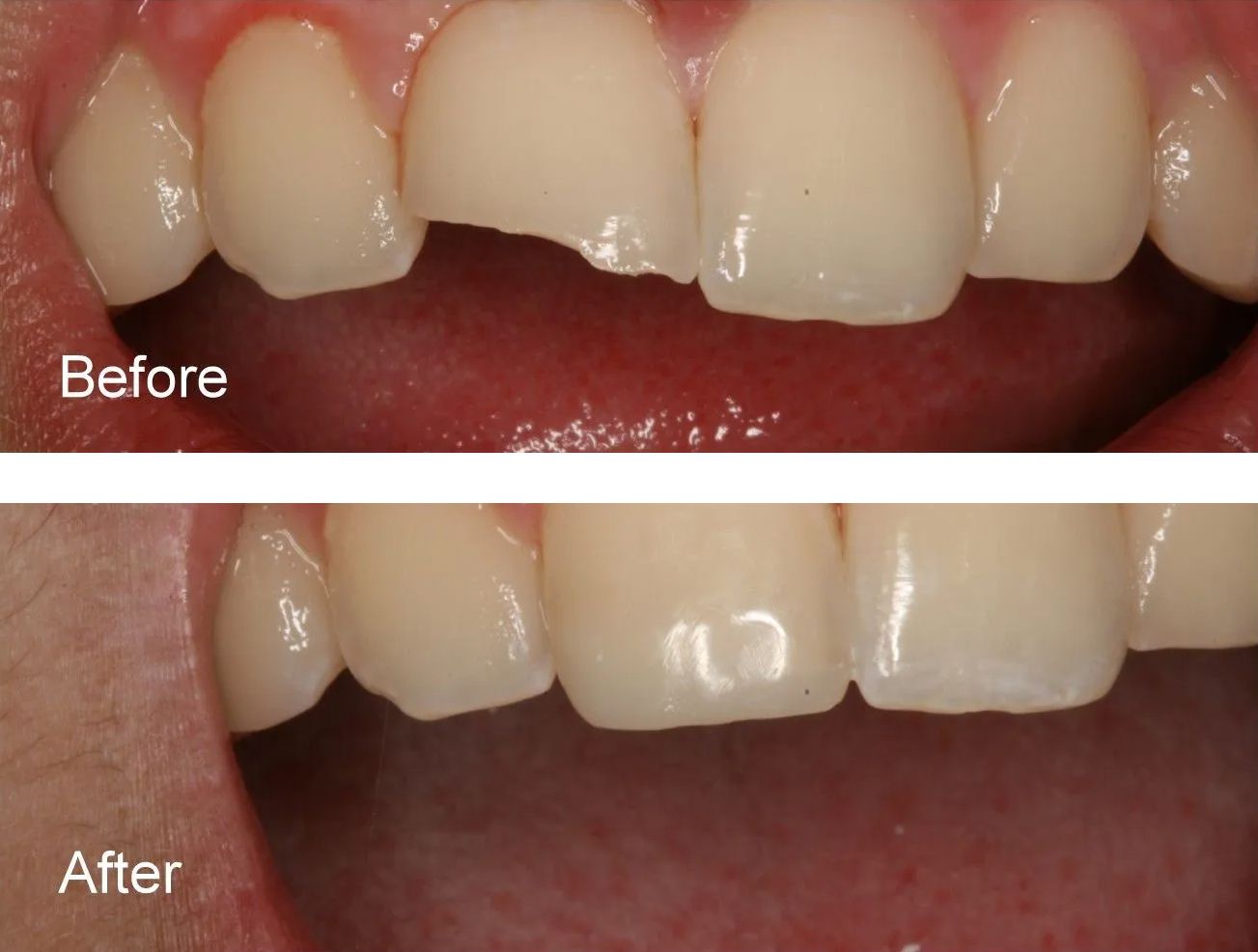 A before and after picture of a person's teeth.