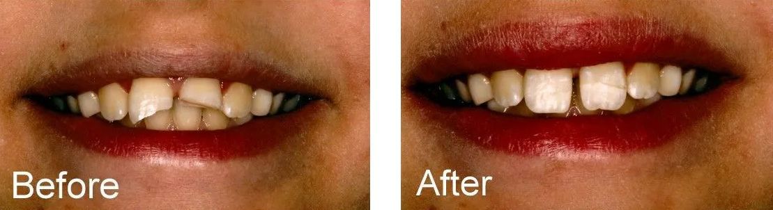 A before and after picture of a woman's teeth.