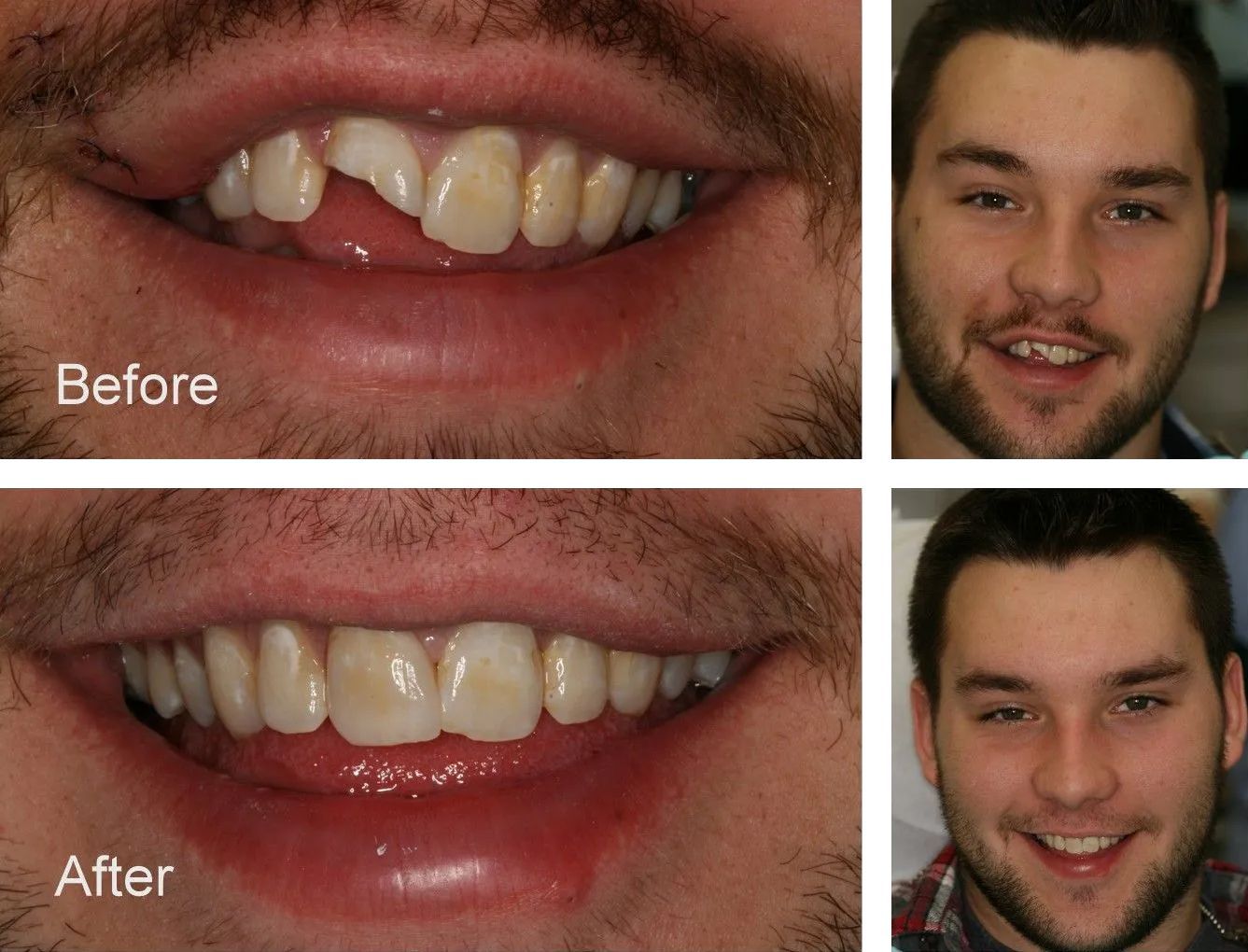 A before and after photo of a man's teeth.