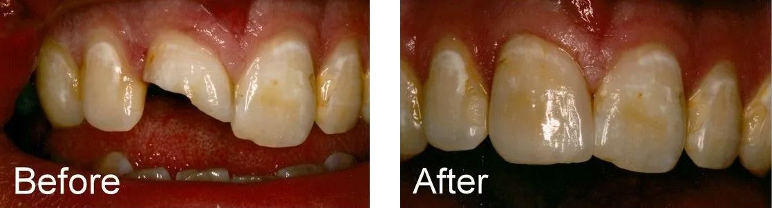 A before and after picture of a person's teeth.