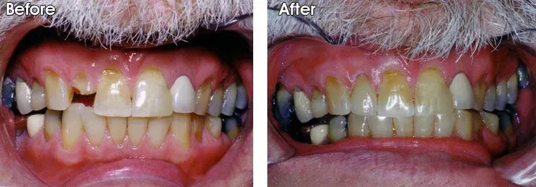 A before and after picture of a man's teeth.