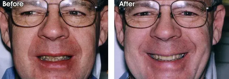 A before and after picture of a person's teeth.