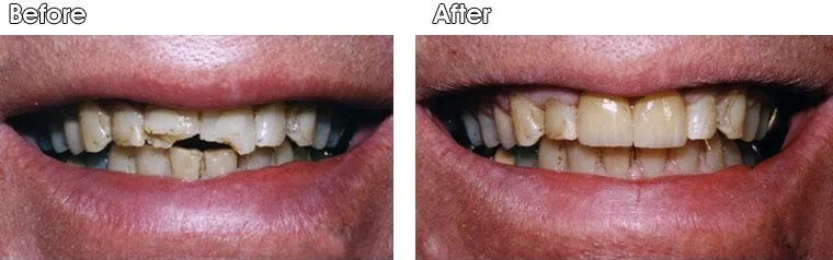 A before and after picture of a person's teeth.