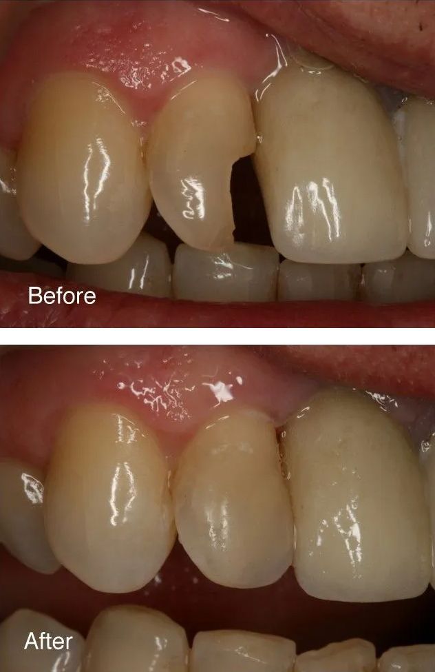 A before and after picture of a person's teeth.
