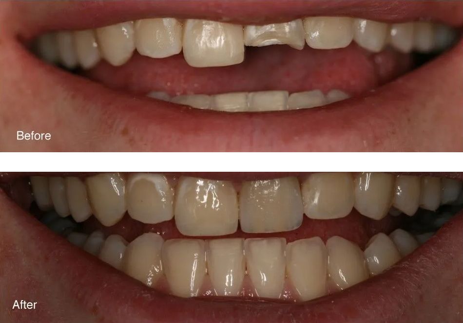 A before and after picture of a person's teeth.