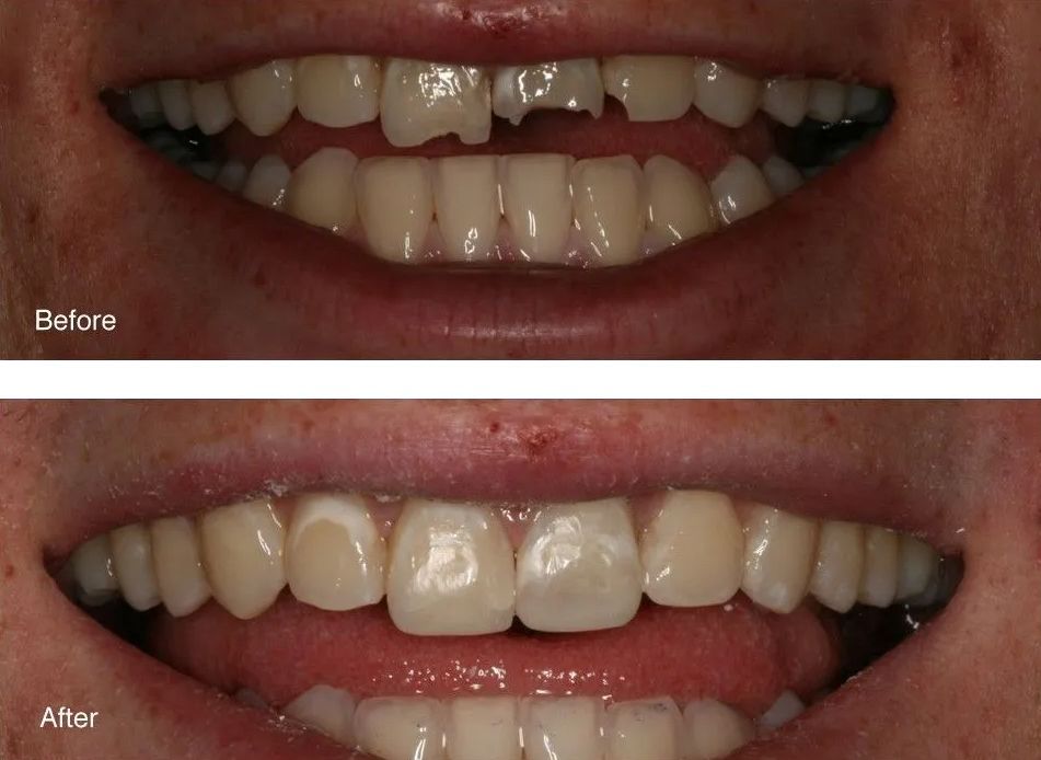 A before and after picture of a person's teeth.