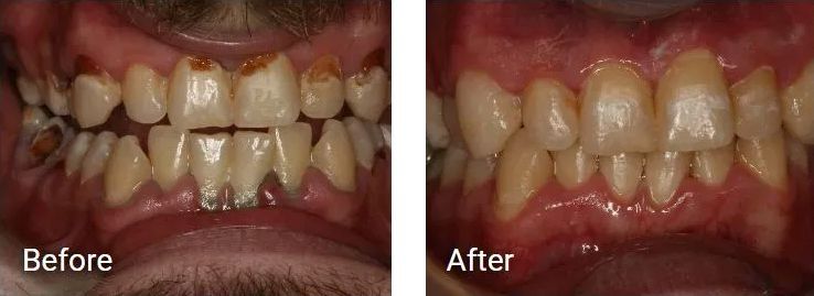 A before and after picture of a person's teeth.
