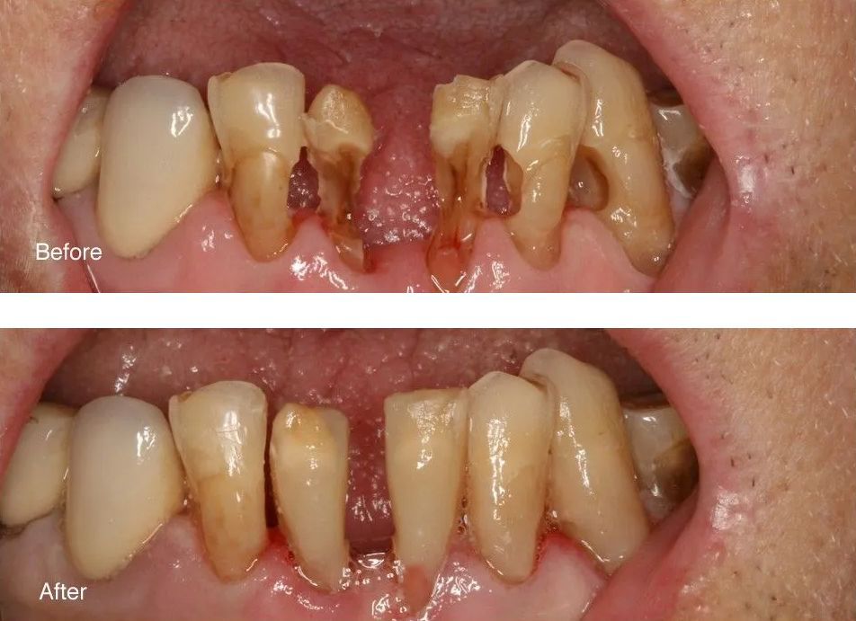 A before and after picture of a person's teeth.