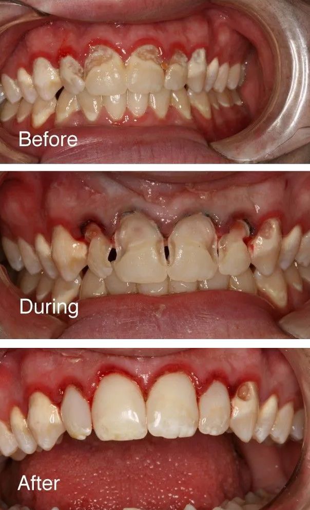 A before and after picture of a person's teeth.