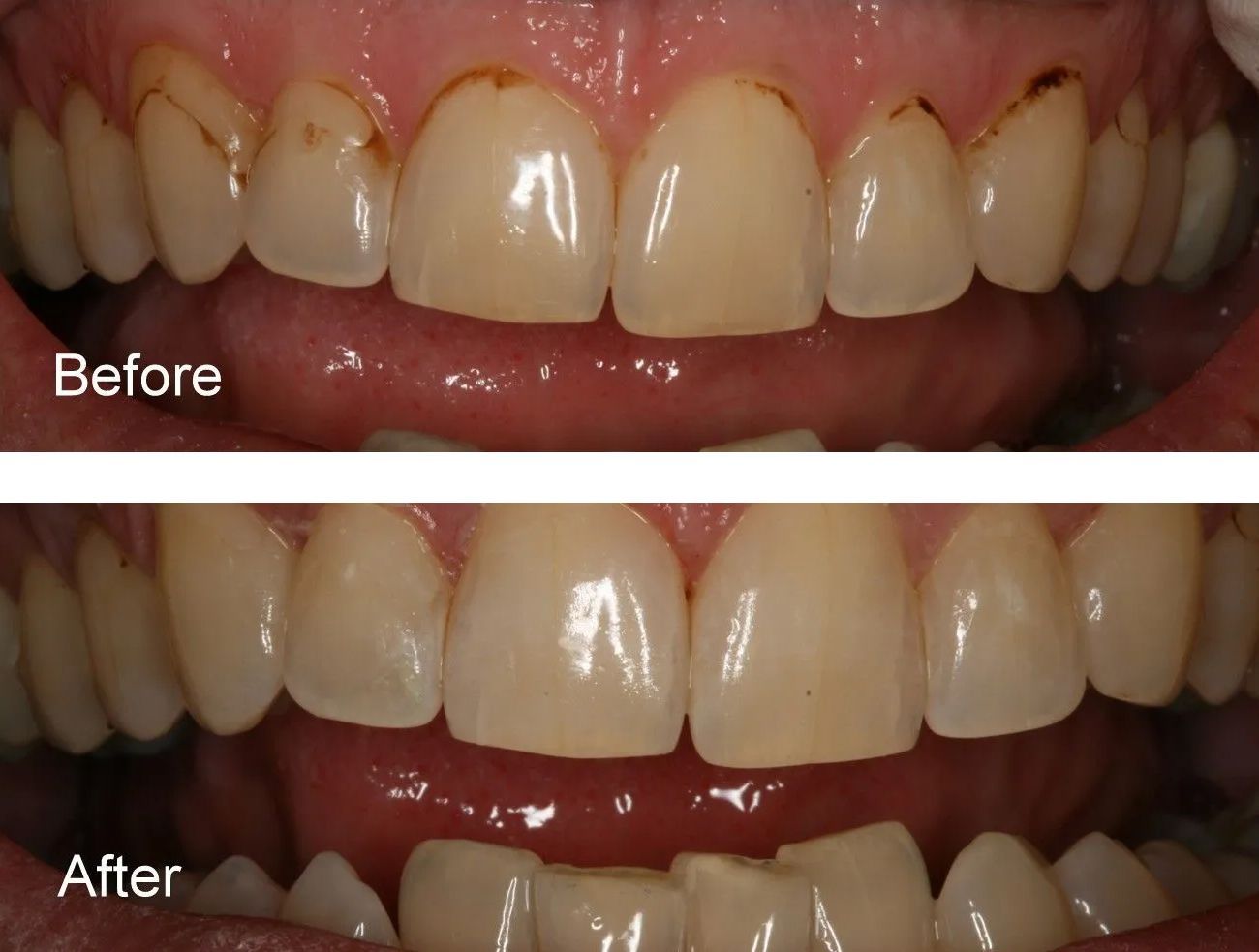 A before and after picture of a person's teeth.