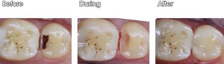 A before and after picture of a person's teeth.