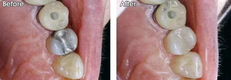 A before and after picture of a person's teeth.