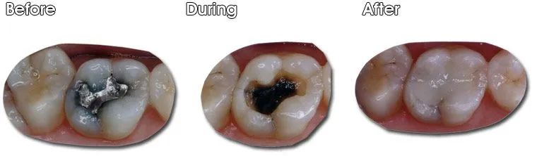 A before and after picture of a person's teeth.