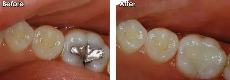 A before and after picture of a person's teeth.