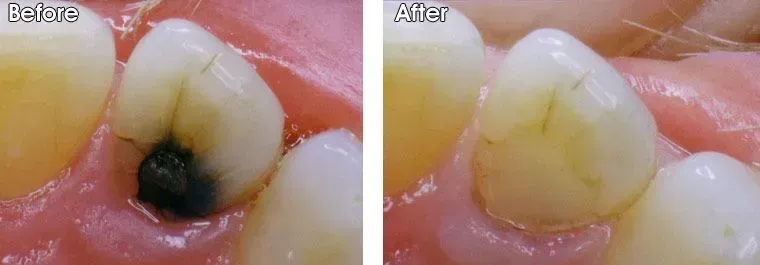 A before and after picture of a tooth with a hole in it.