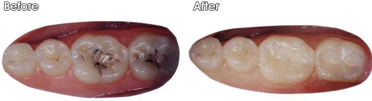A before and after picture of a person's teeth.