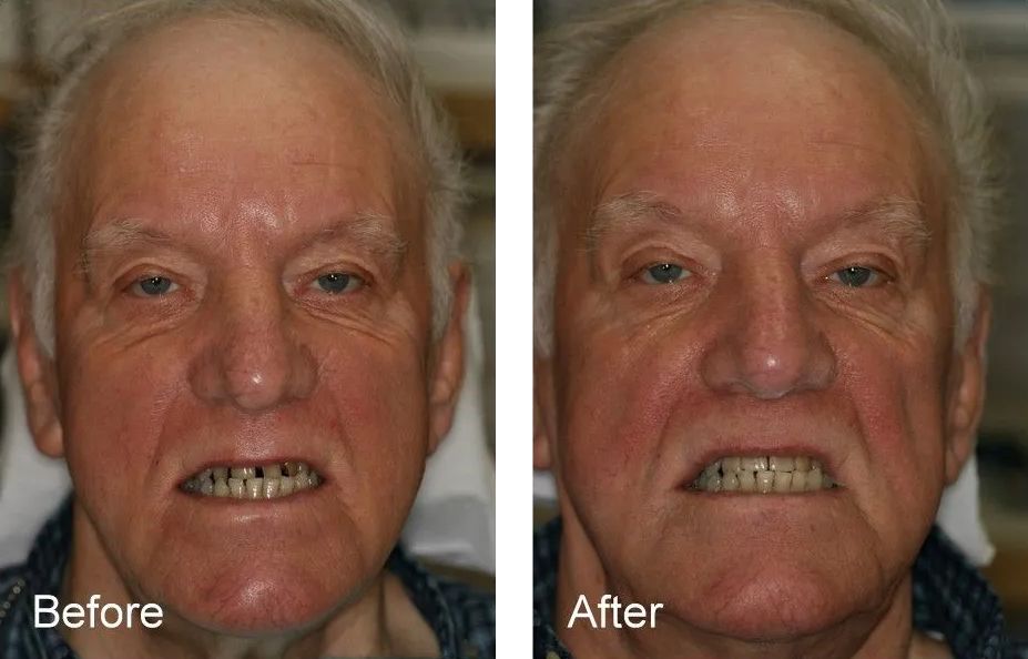 A before and after photo of an elderly man's showing his teeth.