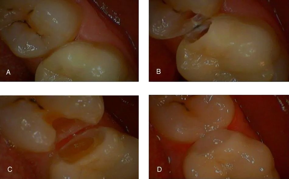 Four pictures of a person's teeth showing different stages of tooth decay.