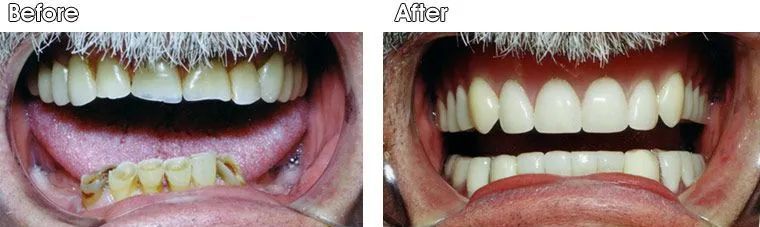A before and after picture of a person's teeth.