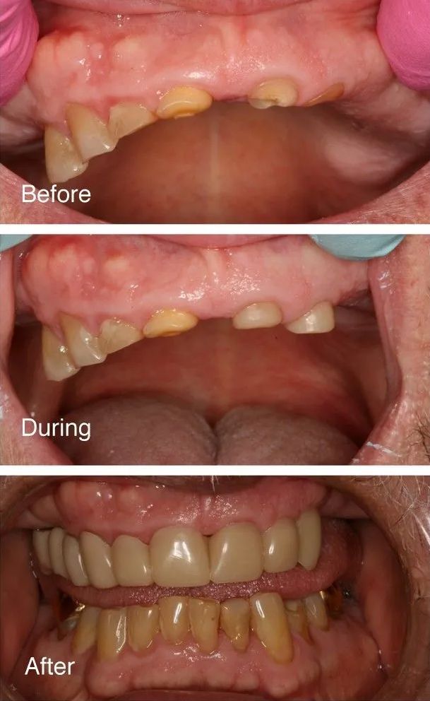 A before and after picture of a person's teeth.