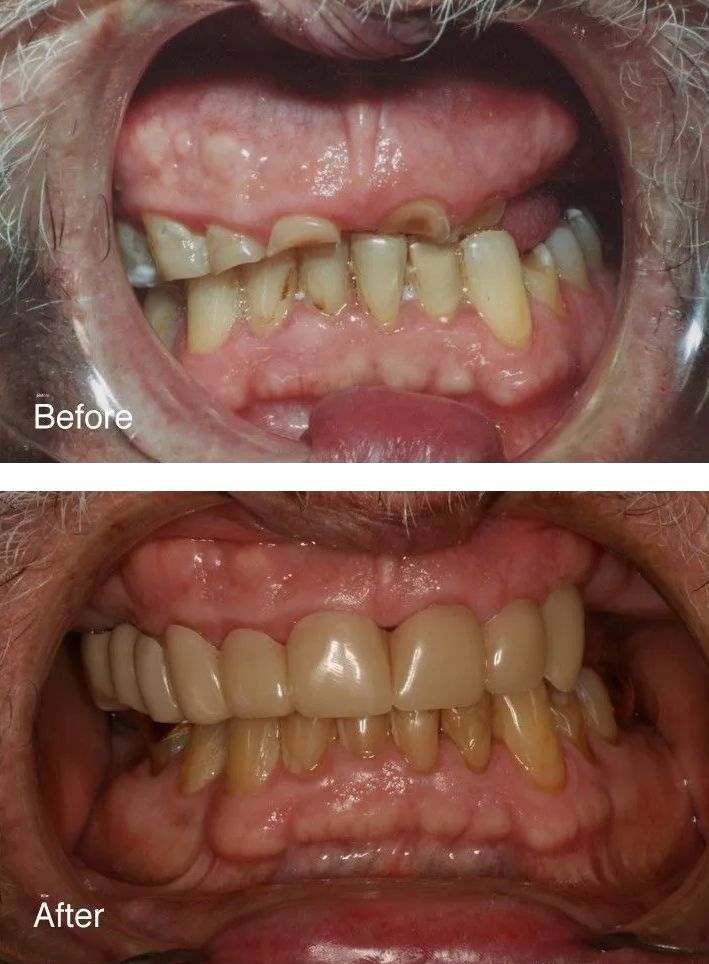 A before and after picture of a person's teeth.