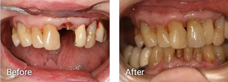 A before and after picture of a person's teeth.