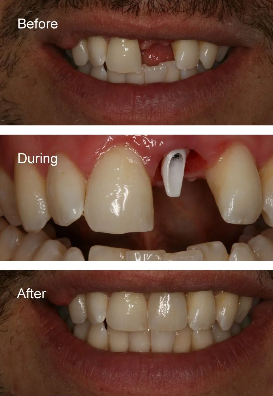 A before and after picture of a man's teeth.