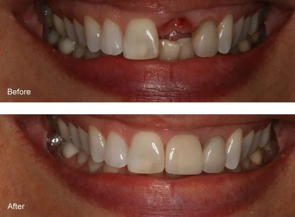 A before and after picture of a woman's teeth.