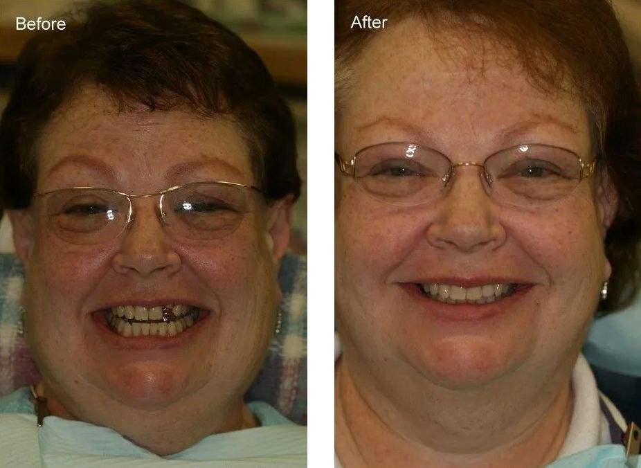 A before and after photo of a woman wearing glasses and smiling.