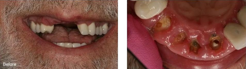 A before and after picture of a man's mouth with missing teeth.