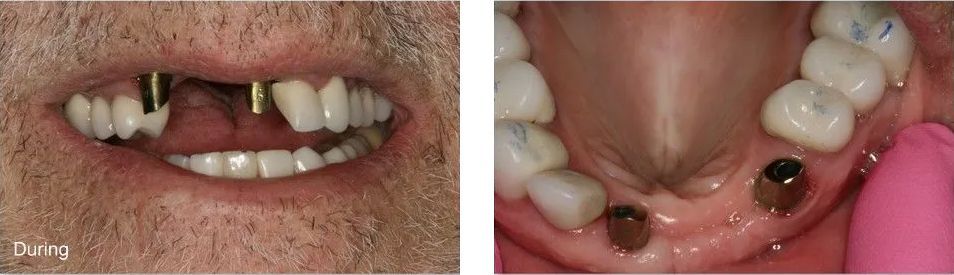 A before and after picture of a man's teeth.
