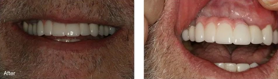 A before and after picture of a man's teeth.