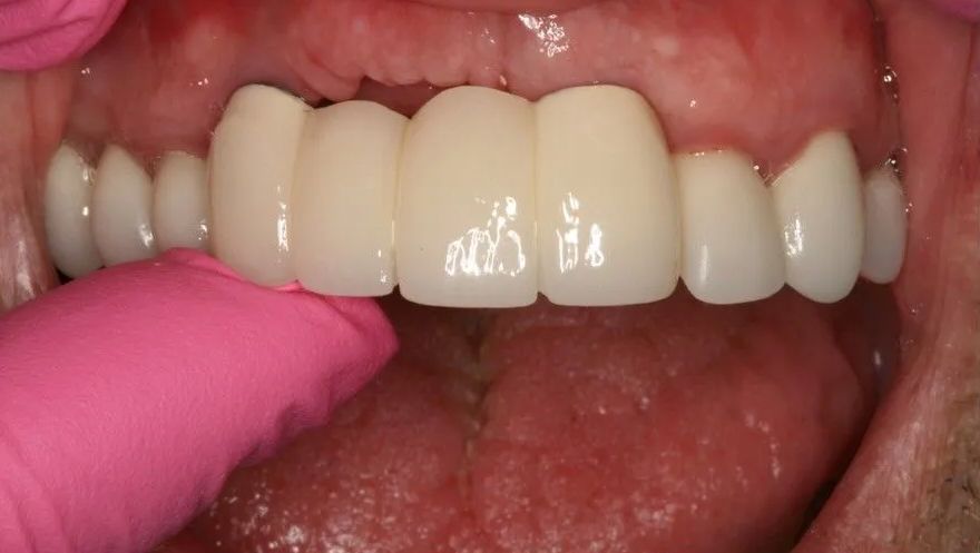 A close up of a person's teeth with a pink glove on.