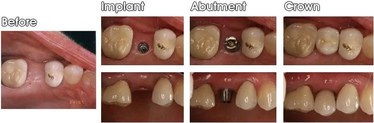 A before and after picture of a person's teeth.