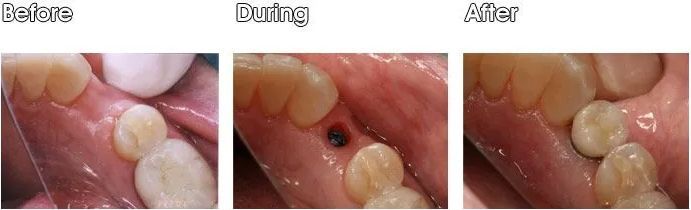 A before and after picture of a person's teeth.