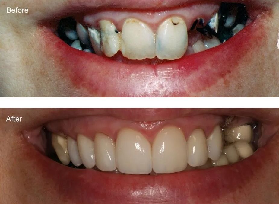 A before and after picture of a person's teeth.