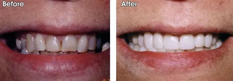 A before and after photo of a woman's teeth.