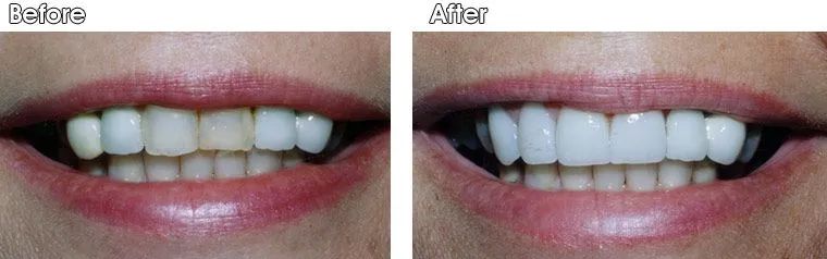 A before and after picture of a woman's teeth.