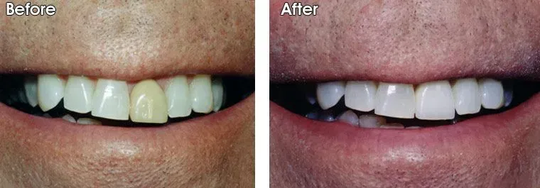 A before and after picture of a man's teeth.