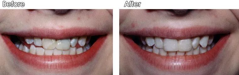A before and after picture of a woman's teeth.