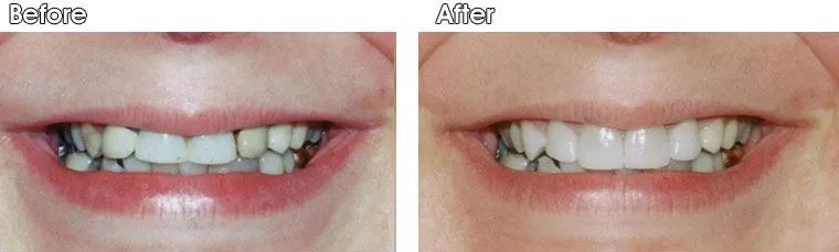 A before and after picture of a woman's teeth.