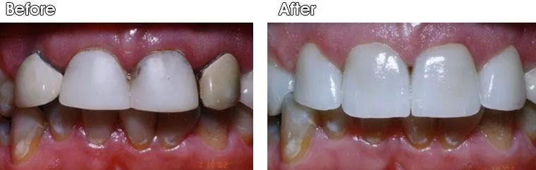A before and after picture of a person's teeth.