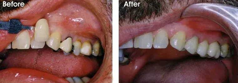 A before and after picture of a person's teeth.