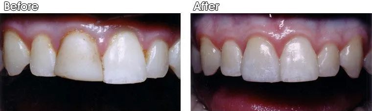 A before and after picture of a person's teeth.