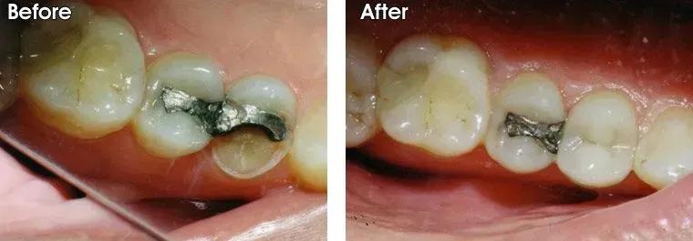 A before and after picture of a person's teeth.