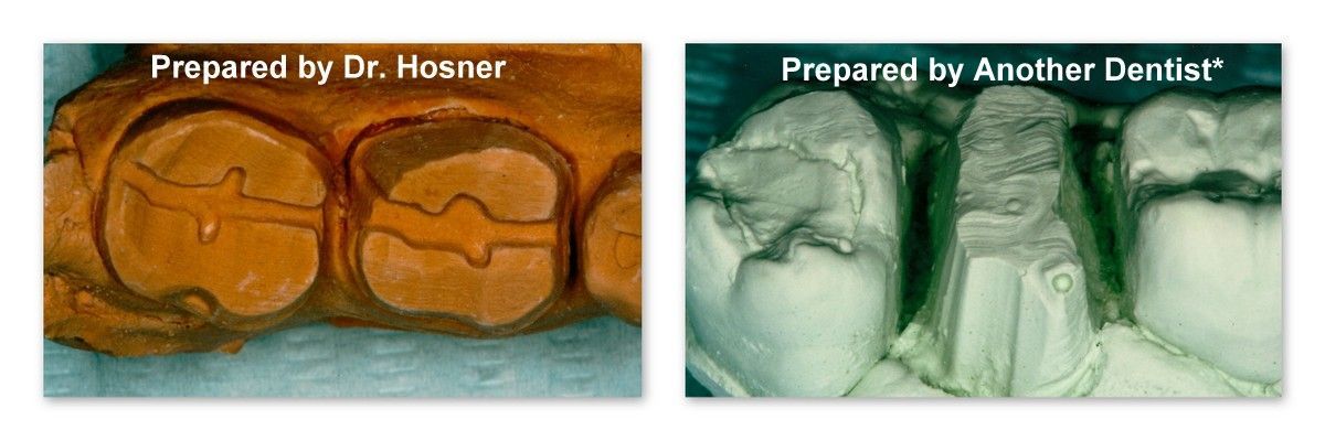 A picture of a tooth before and after being prepared by another dentist