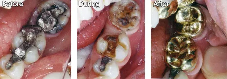 A before and after picture of a person's teeth.