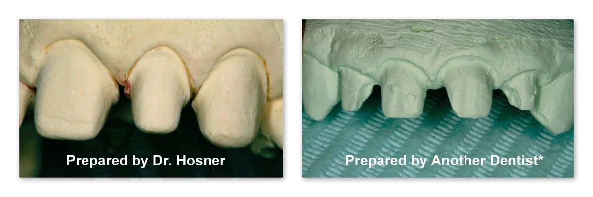Two pictures of teeth prepared by dr. hosner and prepared by another dentist